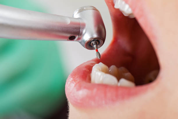 Best Emergency Dental Extractions in Pine Level, NC